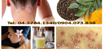 Bệnh vảy nến chữa trị với nghệ vàng