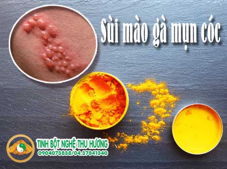 Sùi mào gà, virus, virus HPV, curcumin, nghệ vàng, tinh bột nghệ, sui mao ga, tinh bot nghe, nghe vang, bot nghe