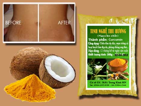 Trị rạn da , nghệ vàng, phụ nữ, phụ nữ sau sinh, bột nghệ, tinh bột nghệ, tri ran da, nghe vang, bot nghe, tinh bot nghe