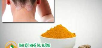 Bệnh vảy nến có thể hạn chế cơn bùng phát vảy nến nhờ nghệ vàng