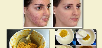 Trị thâm mụn trứng cá với tinh bột nghệ vàng