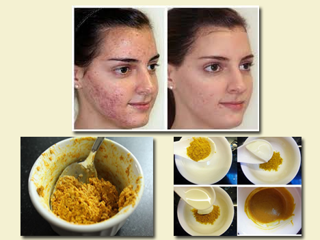 Trị thâm mụn, tinh bột nghệ, bột nghệ, nghệ vàng, mụn trứng cá, tri tham mun, tinh bot nghe, bot nghe, nghe vang, mun trung ca