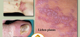 Nghệ vàng chữa lành chứng phát ban da- Bệnh Liken phẳng (Lichen Planus)