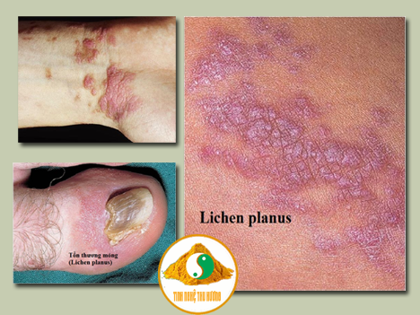 nghệ vàng, liken phẳng, thuốc mỡ, phát ban, tinh bột nghệ, bột nghệ, tinh bot nghe, bot nghe, nghe vang