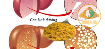 Gan nhiễm mỡ có thể ngăn ngừa nhờ nghệ vàng