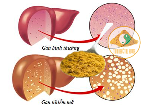 Gan nhiễm mỡ, nghệ vàng, leptin, xơ gan, viêm gan, béo phì, NASH, curcumin, tinh bột nghệ, bột nghệ, tinh bot nghe, bot nghe, nghe vang