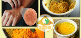 Viêm da dị ứng (bệnh eczema) – ngăn ngừa và điều trị bằng nghệ vàng