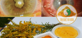 Viêm màng bồ đào – 6 nguyên tắc ngăn ngừa tái phát viêm màng bồ đào