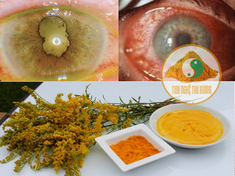 Viêm màng bồ đào, điểm vàng, bệnh viêm màng bồ đào, triệu chứng, đục thủy tinh thể, tinh bột nghệ, bột nghệ, nghệ vàng, tinh bot nghe, bot nghe, nghe vang