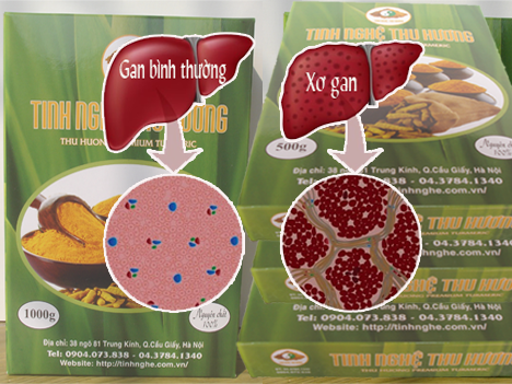 Xơ gan, bệnh xơ gan, tinh bột nghệ, nghệ vàng, bột nghệ, curcumin, tinh bot nghe, xo gan, bot nghe, nghe vang