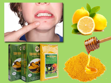 Cách trị mụn, cách trị mụn bọc, trị mụn, mụn bọc, tinh bột nghệ, bột nghệ, nghệ vàng, tinh bot nghe, bot nghe, nghe vang, cach tri mun, tri mun, cach tri mun boc