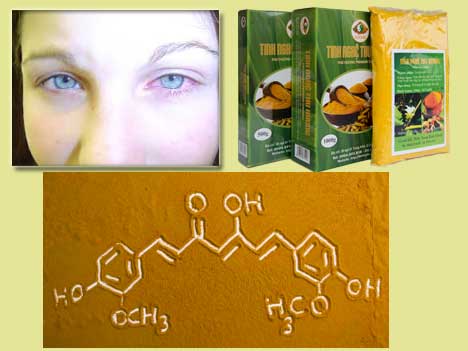 Curcumin, viêm màng bồ đào, viêm màng bồ đào trước, võng mạc, curcumin-phosphatidylcholine, PPAR-γ, nghệ vàng, tinh bột nghệ, nghe vang, tinh bot nghe, bột nghệ, bot nghe, viem mang bo dao