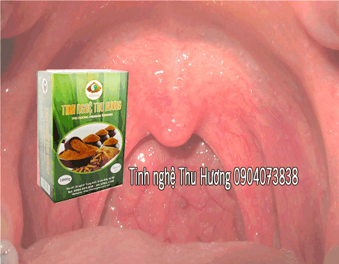 Viêm họng, viêm họng cấp, tinh bột nghệ, bột nghệ, nghệ vàng, tinh bot nghe