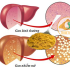 Gan nhiễm mỡ, nghệ vàng, leptin, xơ gan, viêm gan, béo phì, NASH, curcumin, tinh bột nghệ, bột nghệ, tinh bot nghe, bot nghe, nghe vang