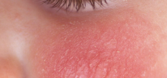 Viêm da dị ứng triệu chứng nguyên nhân và điều trị với nghệ vàng